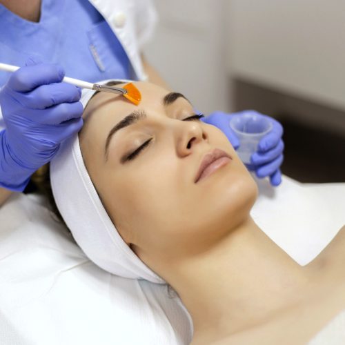 chemical peel